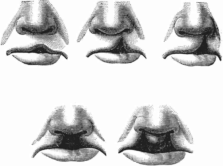 cleft lip & Palate Treatment