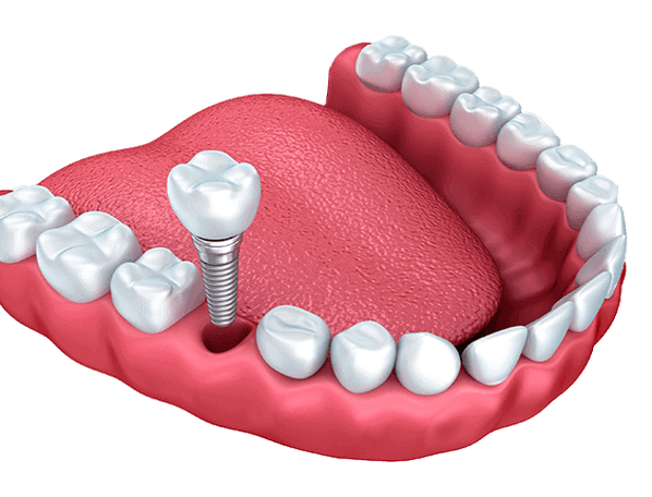 dental-implant-dentistry-tooth